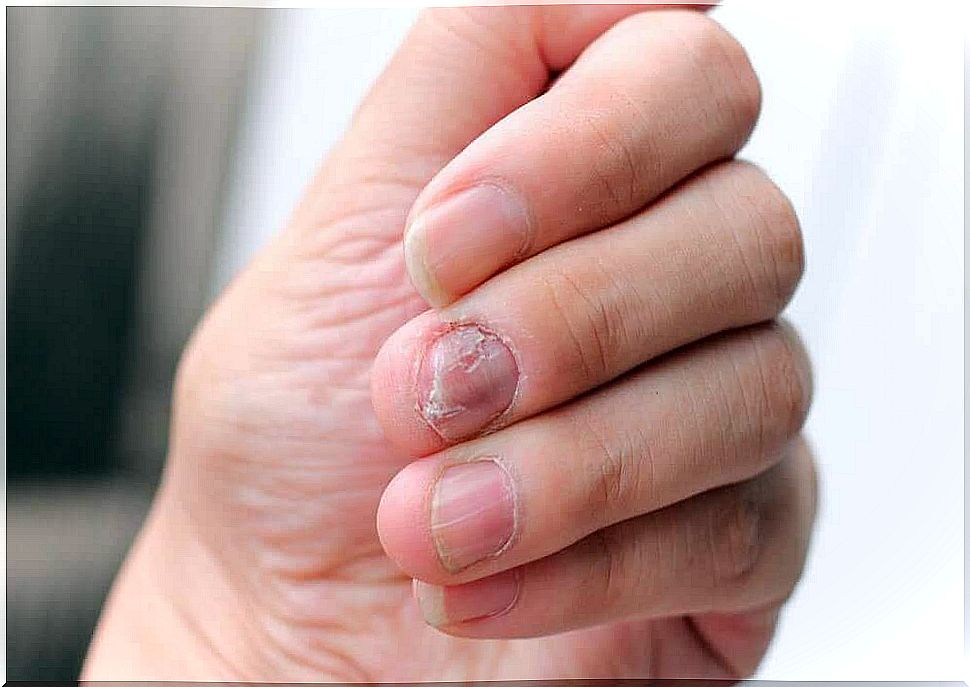 5 natural preparations for psoriasis on the nails