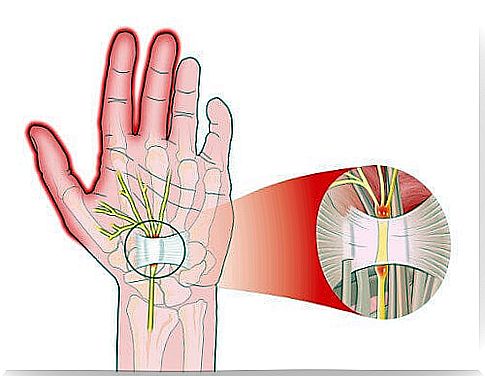 5 ways to relieve pain from carpal tunnel syndrome