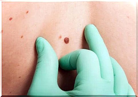 ABCDE test to detect skin cancer