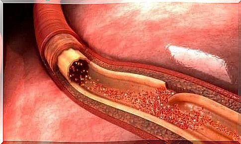 Aortic dissection: What it is and what causes it