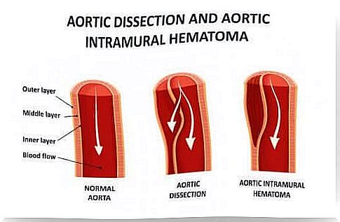 aortic dissection of arteries