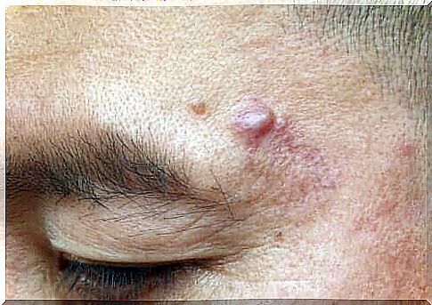 Epidermoid cysts: causes and possible treatments