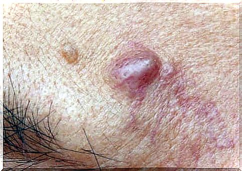 Person with cysts