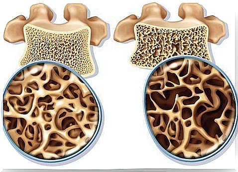 Exercises that treat and prevent osteoporosis