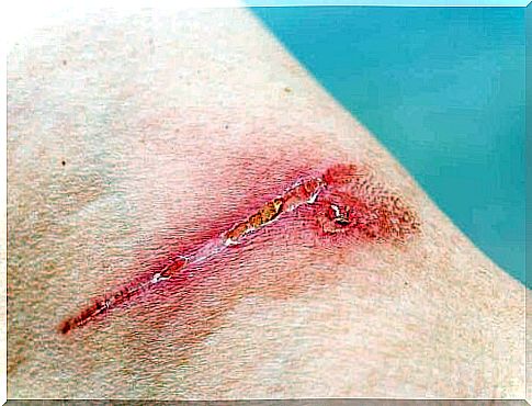 A wound on a person's skin.