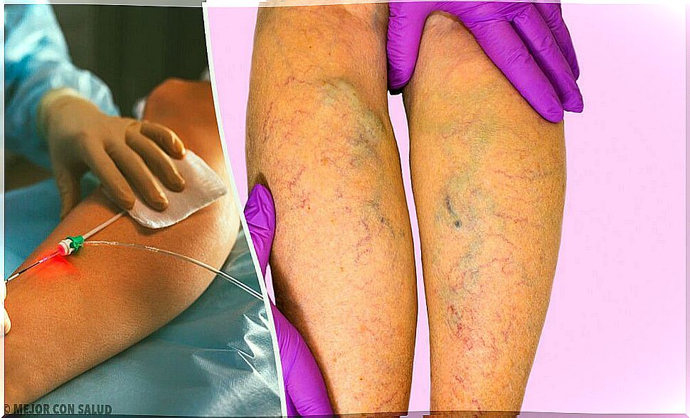 How to treat varicose veins?