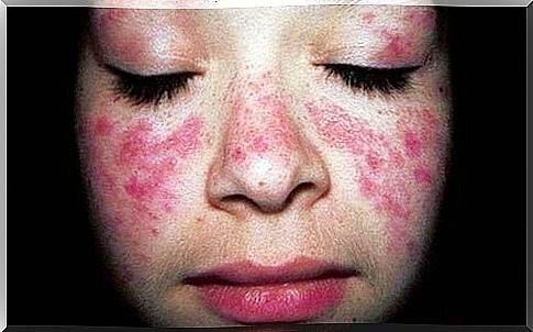 Learn about the treatment for Systemic lupus erythematosus