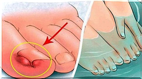 Ingrown toenail