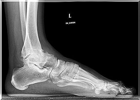 Improper loading is one of the causes of osteoarthritis of the ankles