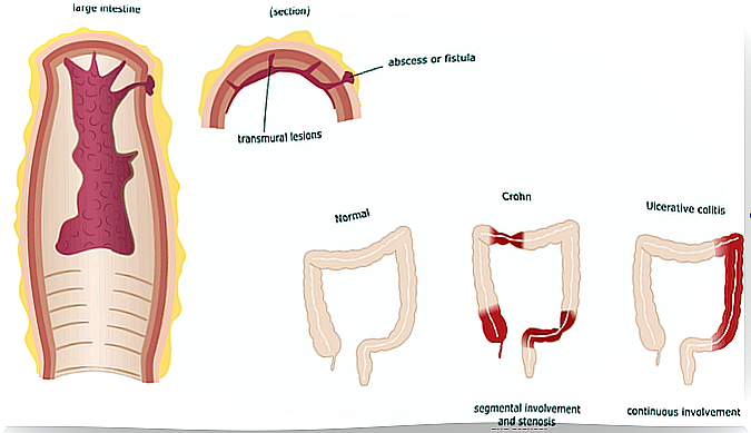 Crohn's disease