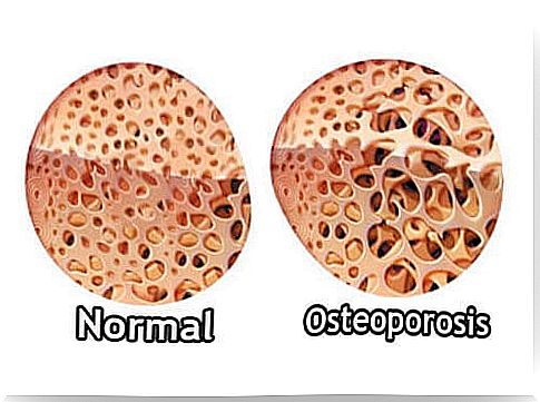 Illustration of osteoporosis